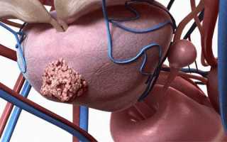 Виды опухолей простаты, симптомы, диагностика, лечение и прогноз