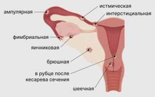 Идет ли менструация при внематочной беременности и признаки патологии