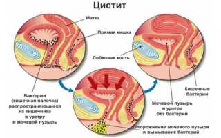 Цистит: чем лечить болезнь у детей