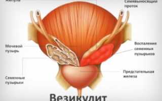 Что такое везикулит: чем опасен, его виды, симптомы, причины и лечение