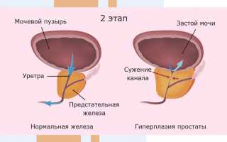 Диффузные изменения и патологии предстательной железы