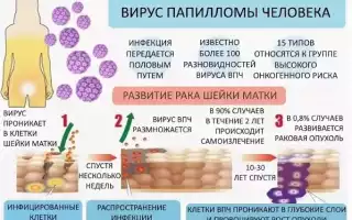 Виды и лечение плоскоклеточной папилломы