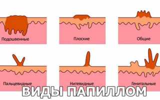 Папилломавирус: как передается и как избежать заражения