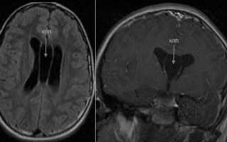 Киста прозрачной перегородки головного мозга