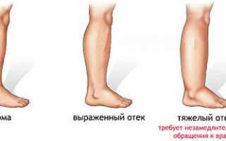 Чем опасна отечность при беременности?