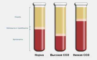 Повышенный уровень СОЭ у ребенка: причины и как обратить внимание на состояние здоровья