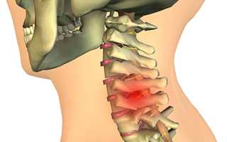 Все о хондрозе шейного отдела позвоночника