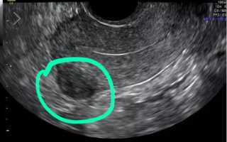 Что показывает УЗИ при миоме матки, эрозии и раковых опухолях шейки матки?
