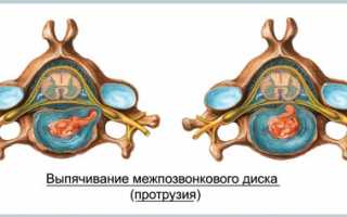 Протрузия межпозвонкового диска l4 l5 s1