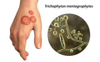 Особенности лечения эпидермофитии