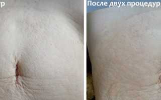 Бадяга и ее применение от растяжек на коже