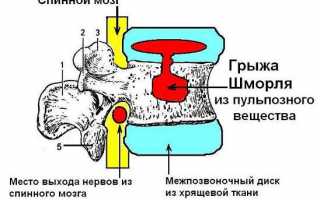 Лечение болезни у которой нет симптомов (Грыжа Шморля)