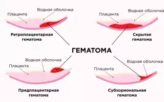 Почему перед родами могут появиться коричневые выделения?