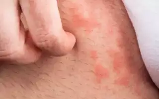 Симптомы и лечение пахового грибка