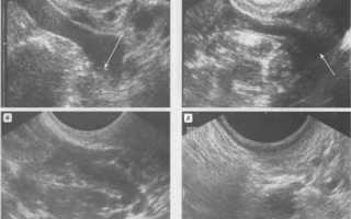 Что означает изменение эхогенности на УЗИ?