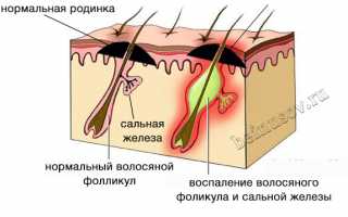 Почему вздулась и болит родинка