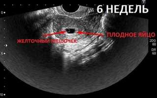 Когда на УЗИ видно плодное яйцо, почему эмбрион не визуализируется на сроке 6–7 недель беременности?