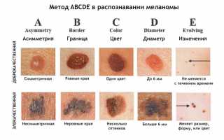 Причины и лечение злокачественных родинок