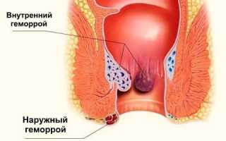 Как снизить влияние геморроя на потенцию