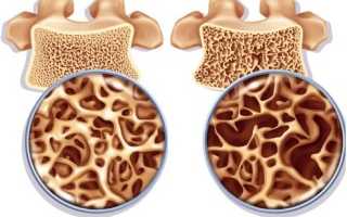 Можно ли лечить остеопроз позвоночника?