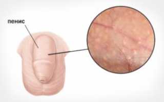 Пупырышки на головке полового члена у мужчин