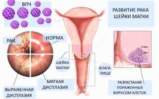 Вирус папилломы человека 39 типа: как передается вирус, симптомы, лечение