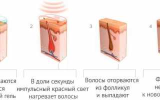 Избавляет ли лазерная эпиляция от волос навсегда: реальность или миф