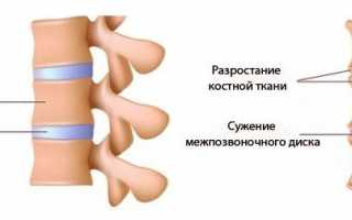 Излечим хондроз поясницы и спины