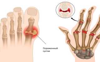 Поражение суставов полиартритом – причины заболевания и способы лечения