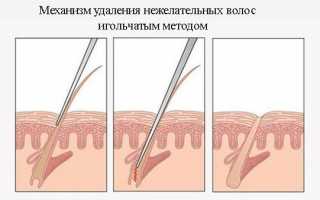 Что лучше – лазерная эпиляция или электроэпиляция: достоинства и недостатки каждого метода