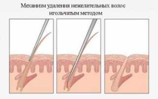 Как работает и на сколько хватает эффекта после электроэпиляции