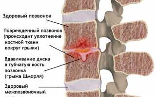 Грыжа Шморля поясничного отдела позвоночника