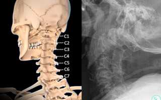 Грыжа межпозвоночных дисков C3-C4, C4-C5, C5-C6, C6-C7: диагностика и причины возникновения