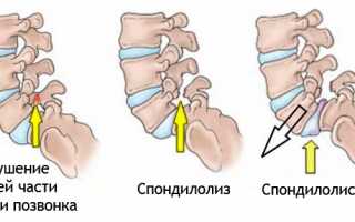 Симптомы и лечение смещения позвонков