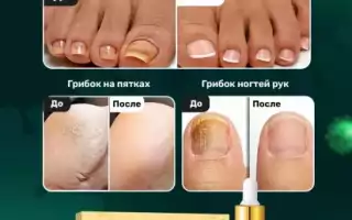 Какое использовать средство от грибка на ногах
