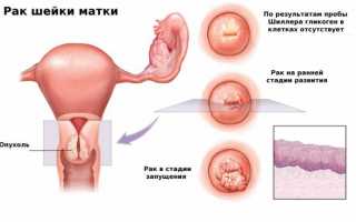 Какую опасность представляют папилломы