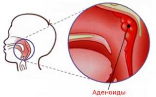 Как применяют протаргол при аденоидах?