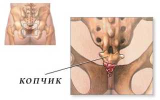 Выявляем и лечим кокцигодинию
