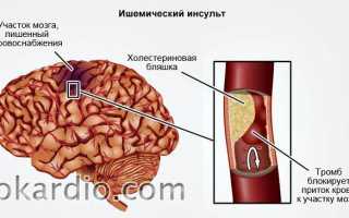 Инфаркт мозга