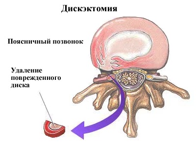 Что происходит при дискэктомии