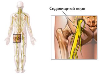Ишиалгию вызывает ущемление седалищного нерва