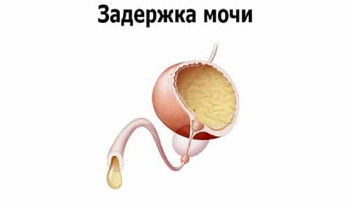 Фолликулярная стадия простатита характеризуется полной задержкой мочи